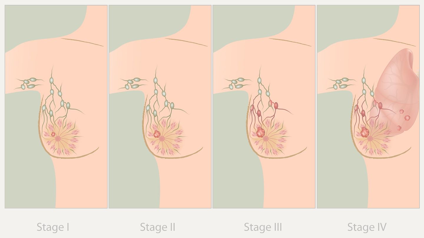 Breast cancer treatment – Radiotherapy